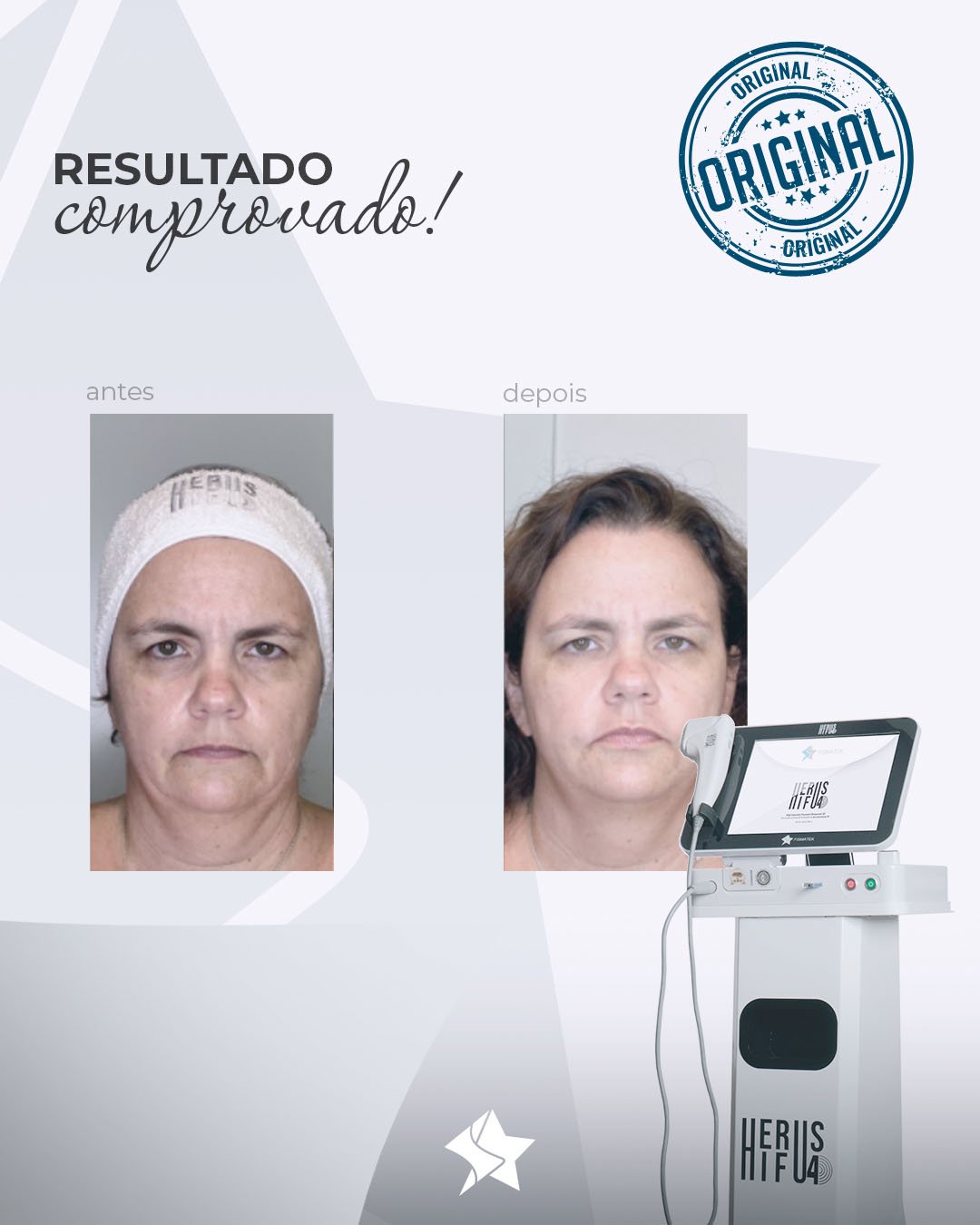 Resultados-Herus-HIFU-4D-23-1
